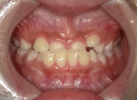 小児矯正はいつから始める？1期治療で終わらせるために大切な「顎の発達」の考え方